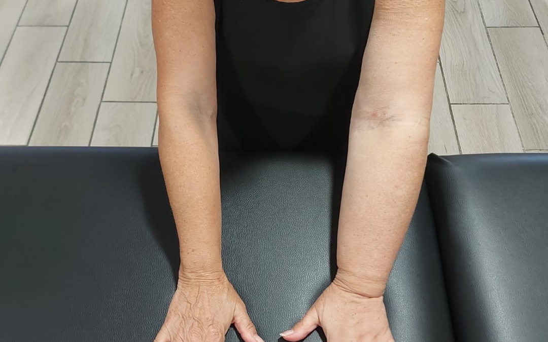 Lymphedema